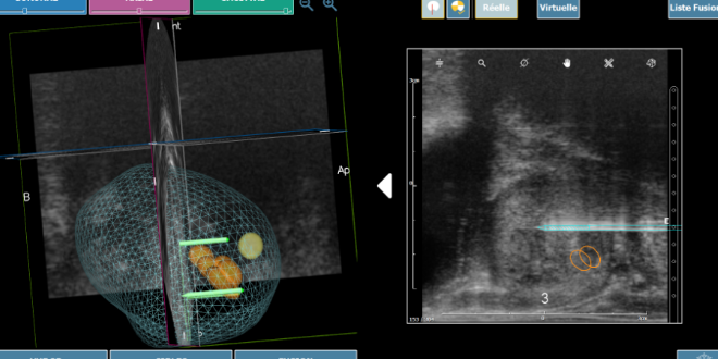 Cancer de la prostate : première utilisation au monde de la technique d’ablation tumorale Nanoknife® guidée en imagerie embarquée 3D en ambulatoire