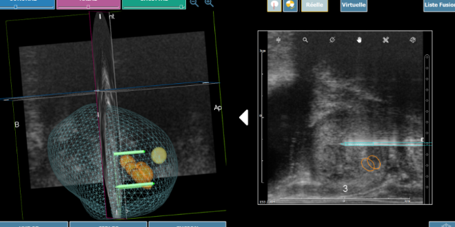 Cancer de la prostate : première utilisation au monde de la technique d’ablation tumorale Nanoknife® guidée en imagerie embarquée 3D en ambulatoire 